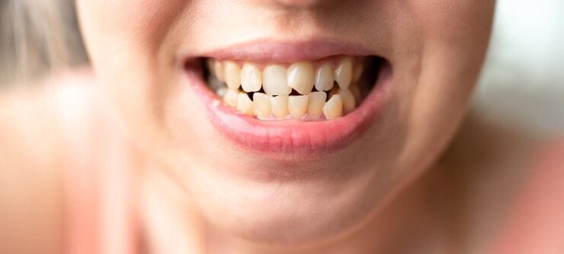Sognare Denti Rotti: Significato e Interpretazione